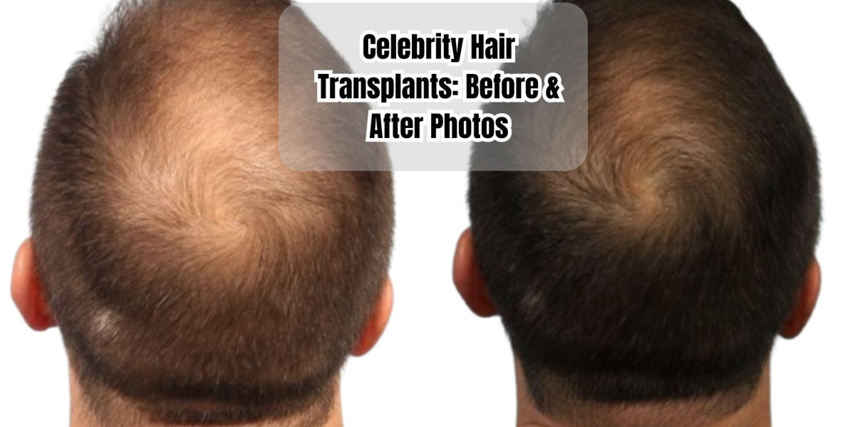 Celebrity Hair Transplants: Before & After Photos